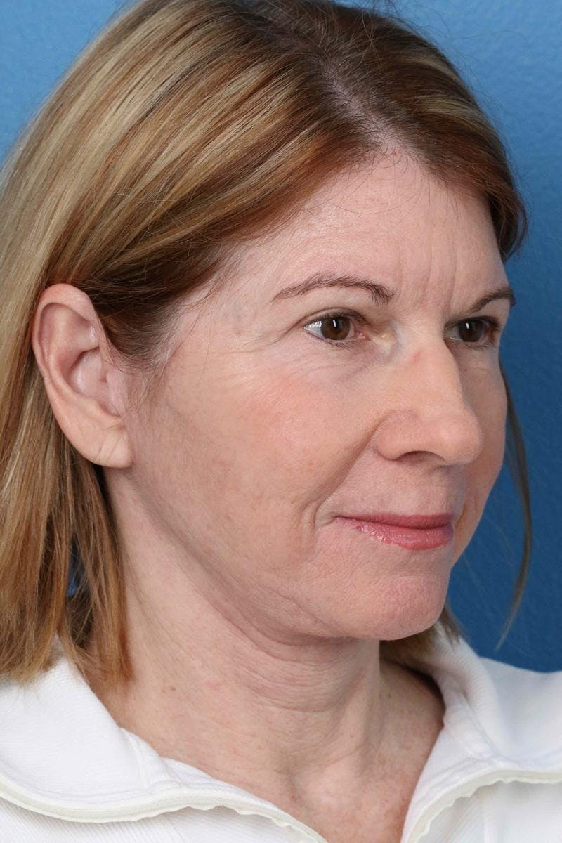 Energy Assisted Face/Neck Lift Before & After Gallery - Patient 390579 - Image 4