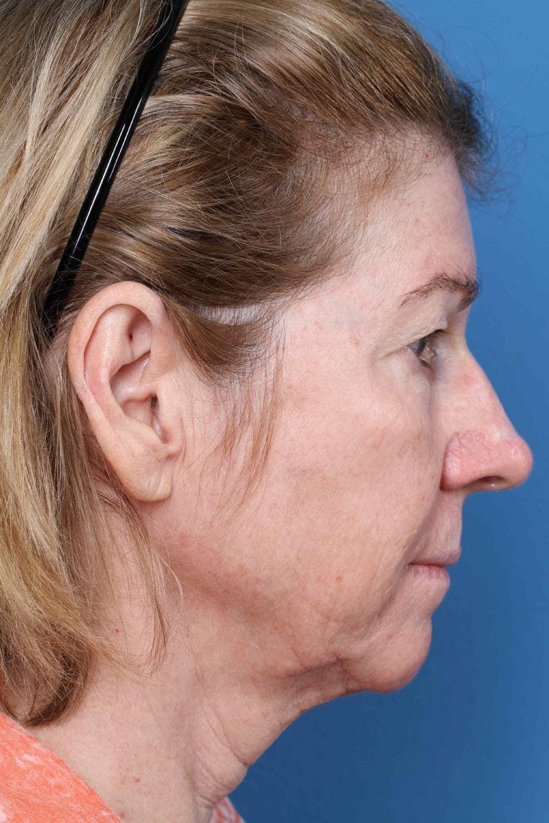 Energy Assisted Face/Neck Lift Before & After Gallery - Patient 390579 - Image 5