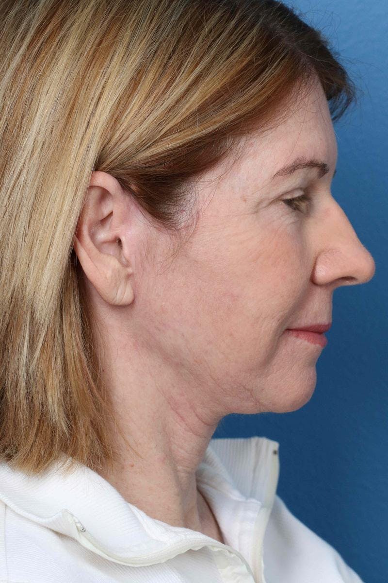 Energy Assisted Face/Neck Lift Before & After Gallery - Patient 390579 - Image 6