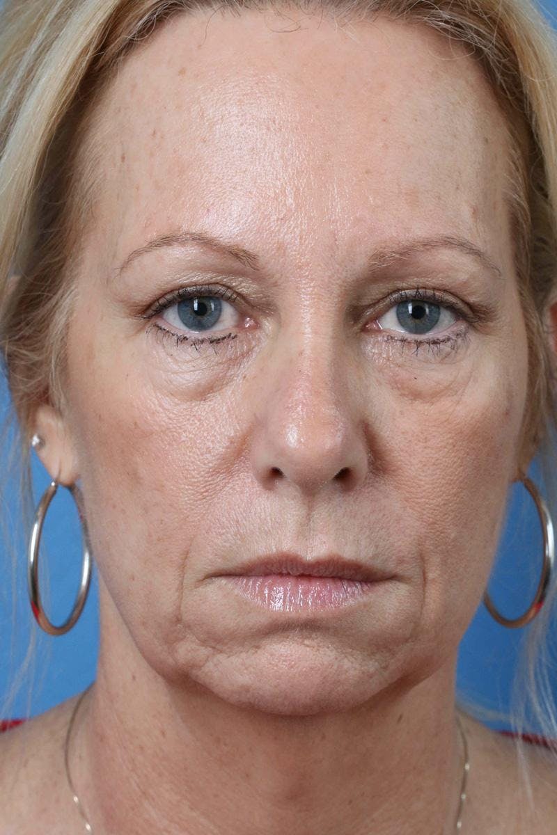 Energy Assisted Face/Neck Lift Before & After Gallery - Patient 363554 - Image 1