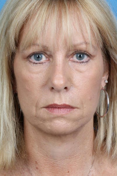 Energy Assisted Face/Neck Lift Before & After Gallery - Patient 363554 - Image 2