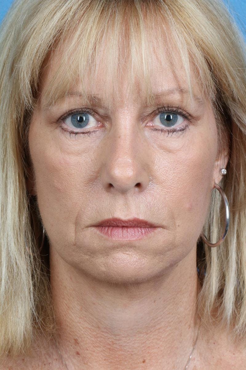 Energy Assisted Face/Neck Lift Before & After Gallery - Patient 363554 - Image 2
