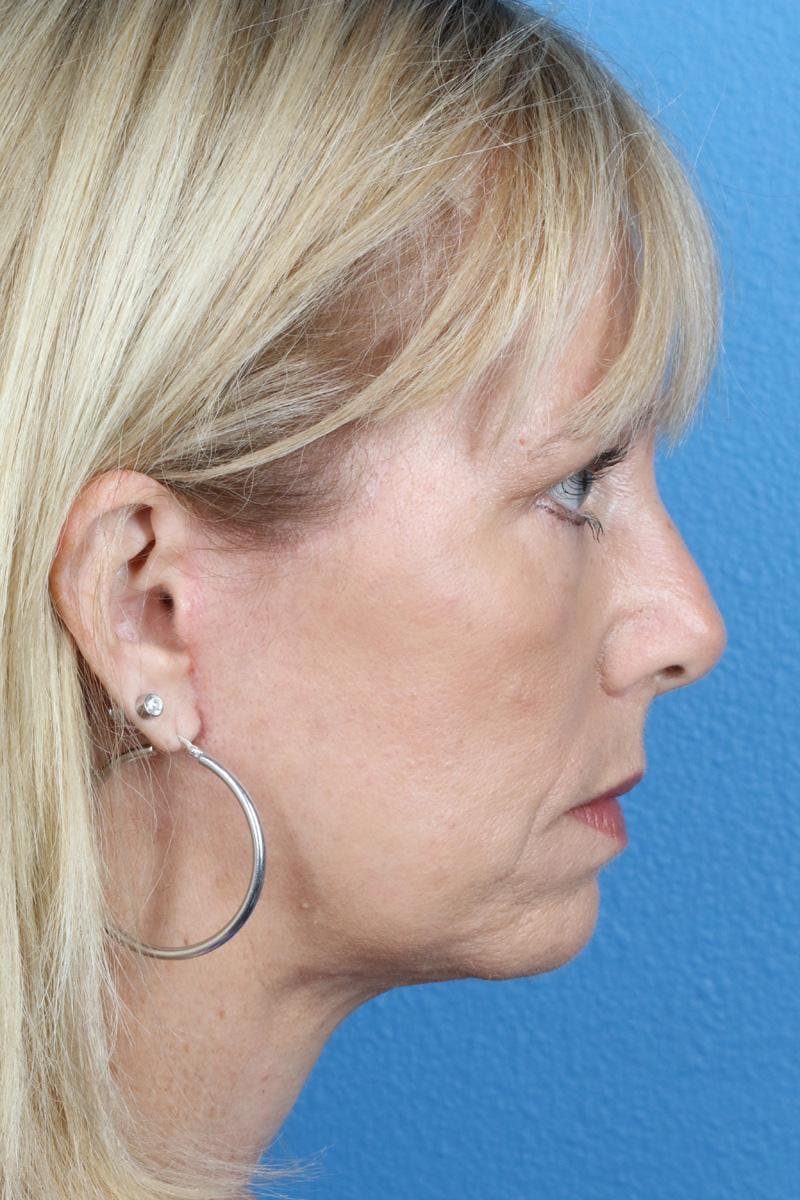 Energy Assisted Face/Neck Lift Before & After Gallery - Patient 363554 - Image 6
