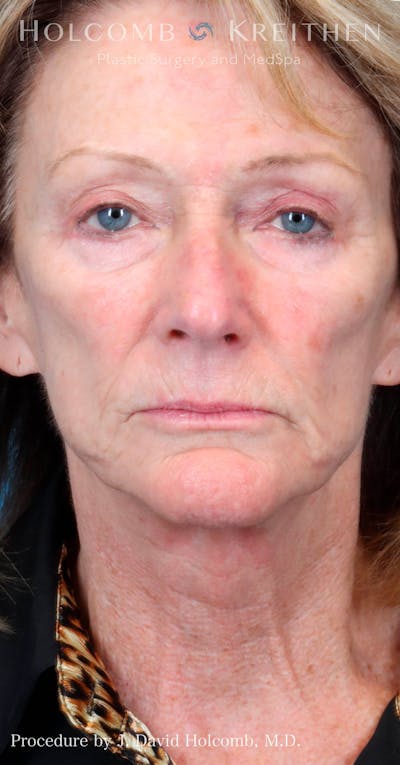 Energy Assisted Face/Neck Lift Before & After Gallery - Patient 428737 - Image 1