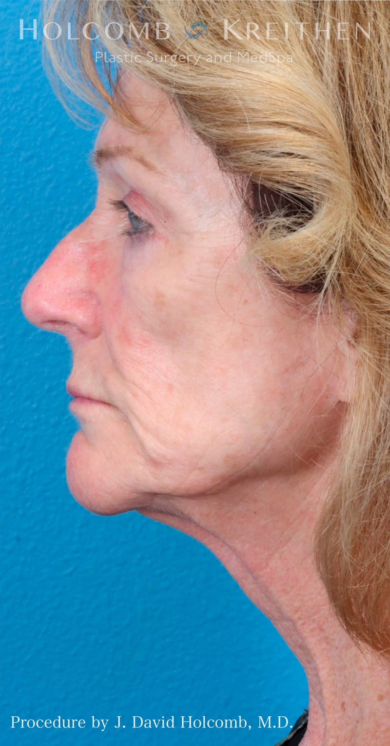 Energy Assisted Face/Neck Lift Before & After Gallery - Patient 428737 - Image 3