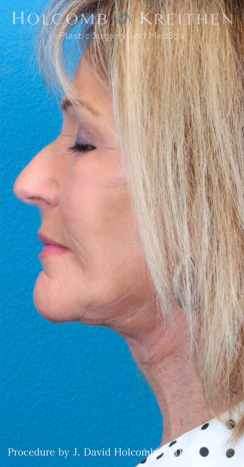 Energy Assisted Face/Neck Lift Before & After Gallery - Patient 428737 - Image 4
