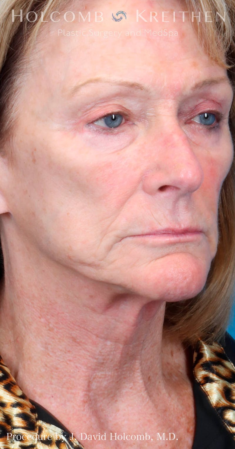 Energy Assisted Face/Neck Lift Before & After Gallery - Patient 428737 - Image 5