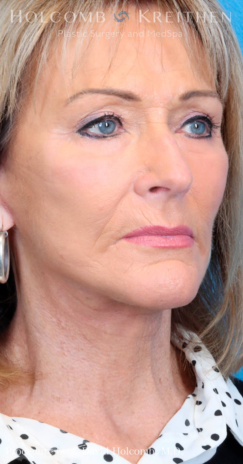 Energy Assisted Face/Neck Lift Before & After Gallery - Patient 428737 - Image 6