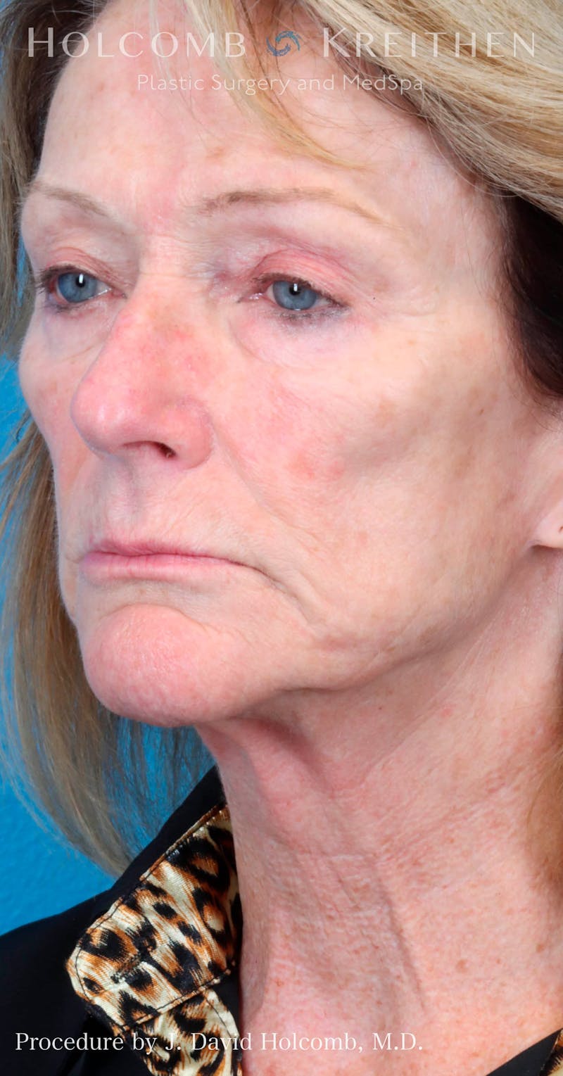 Energy Assisted Face/Neck Lift Before & After Gallery - Patient 428737 - Image 7