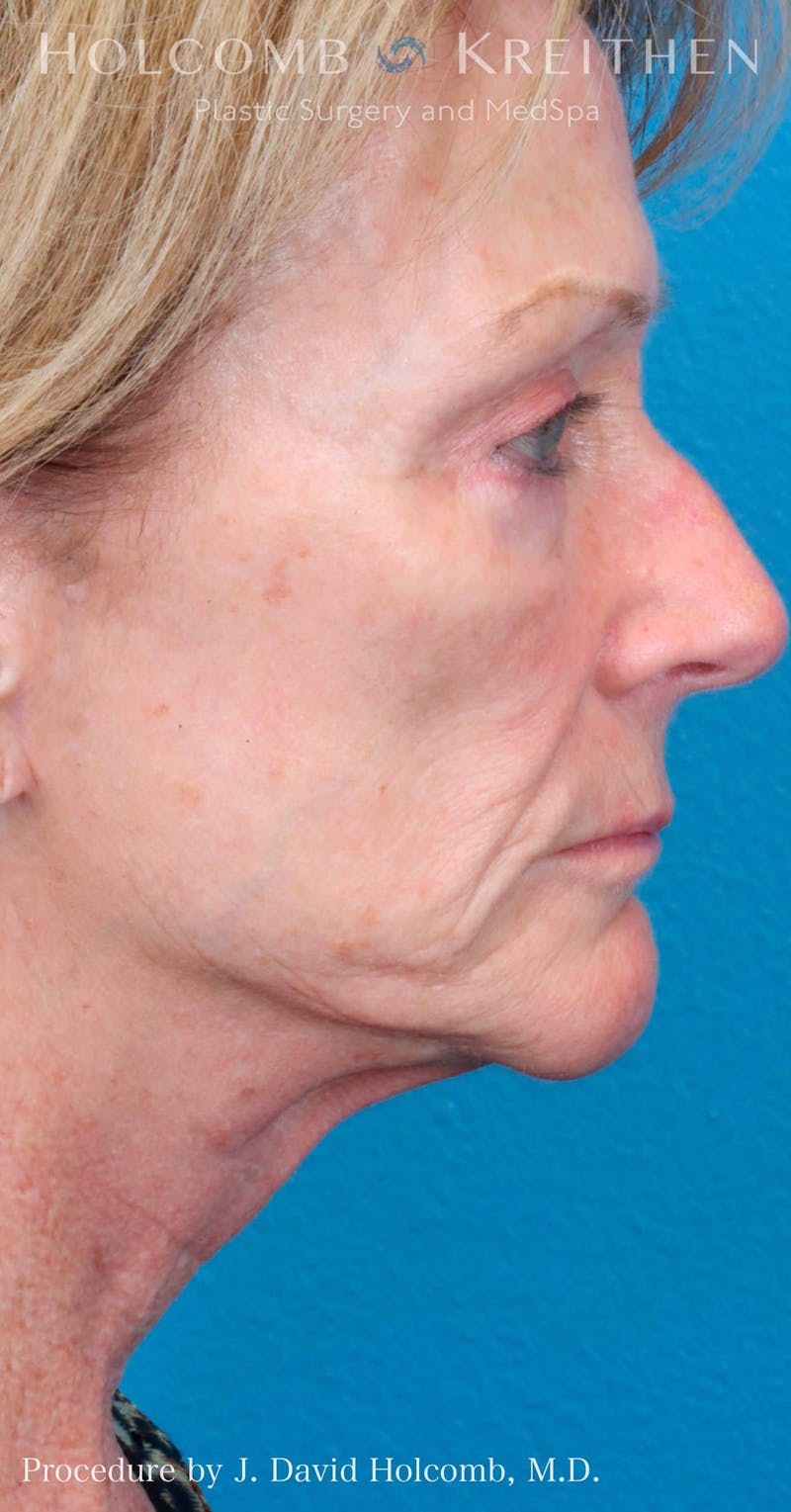 Energy Assisted Face/Neck Lift Before & After Gallery - Patient 428737 - Image 9