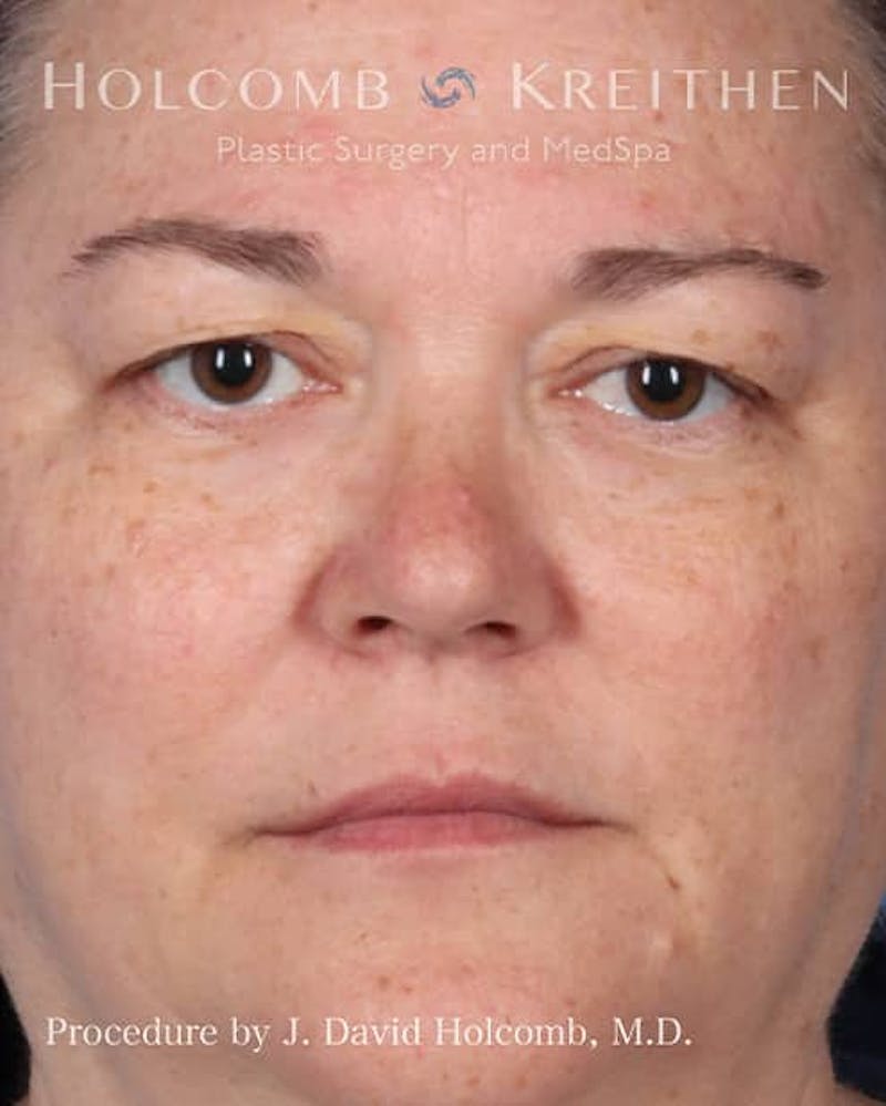 eCO2 Fractional Laser Before & After Gallery - Patient 397939 - Image 1