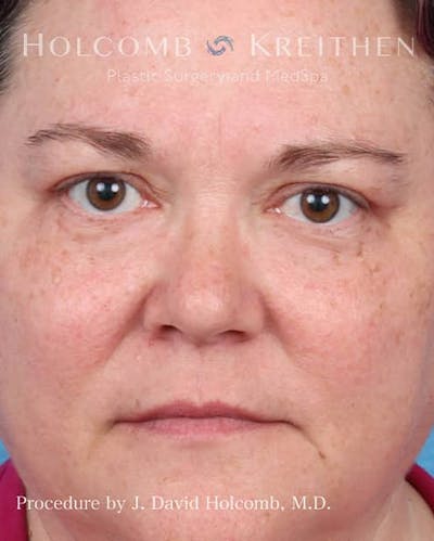 eCO2 Fractional Laser Before & After Gallery - Patient 397939 - Image 2
