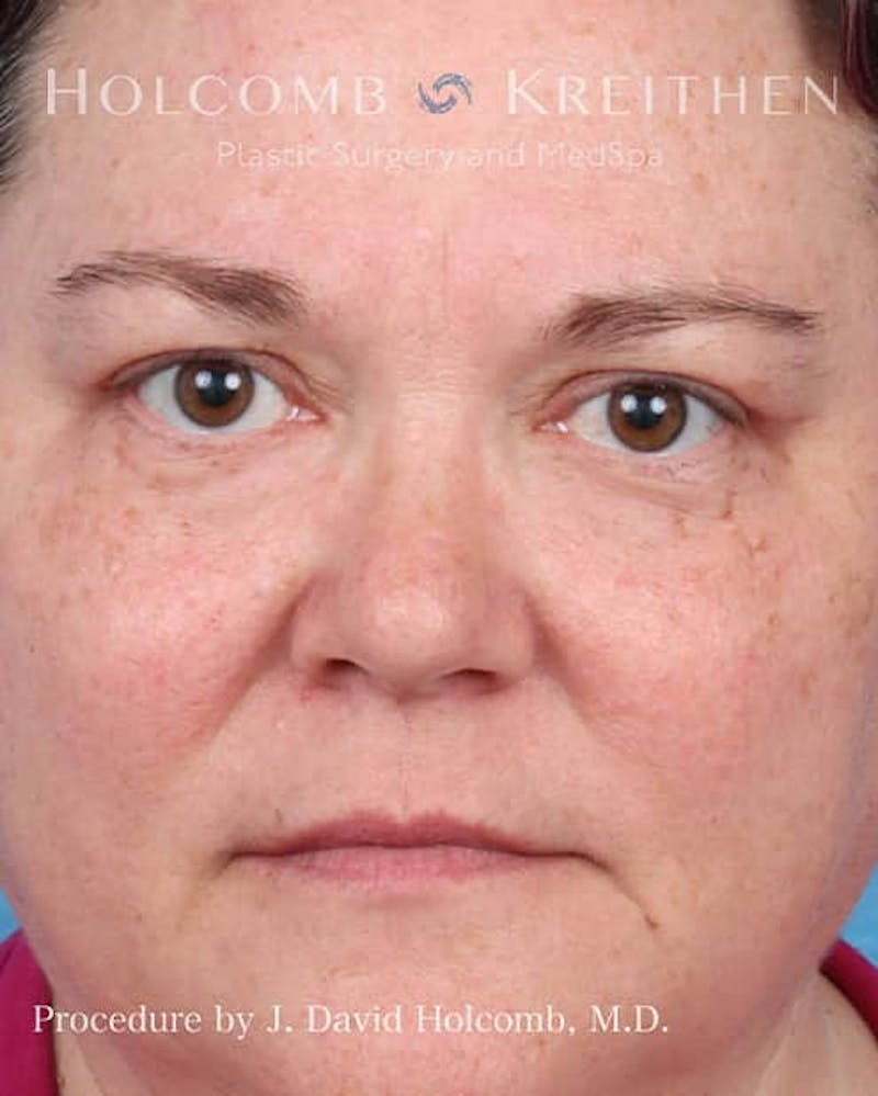 eCO2 Fractional Laser Before & After Gallery - Patient 397939 - Image 2