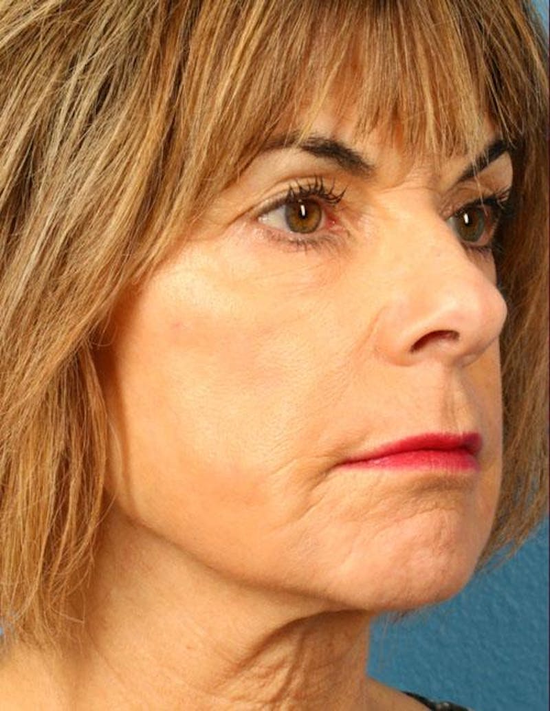 Fat Grafting Before & After Gallery - Patient 289066 - Image 1