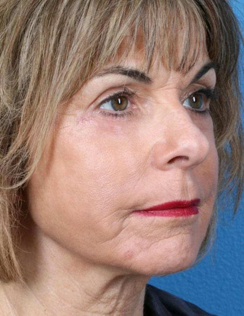 Fat Grafting Before & After Gallery - Patient 289066 - Image 2