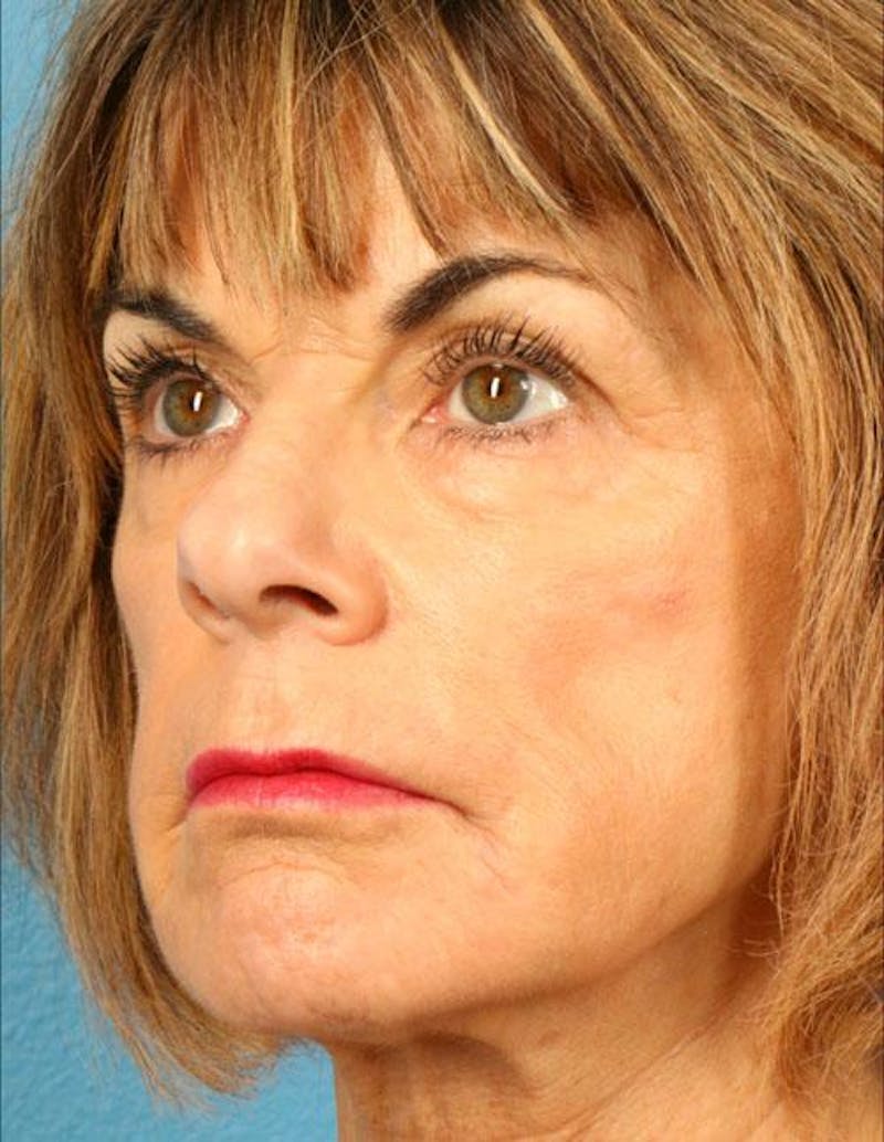 Fat Grafting Before & After Gallery - Patient 289066 - Image 3