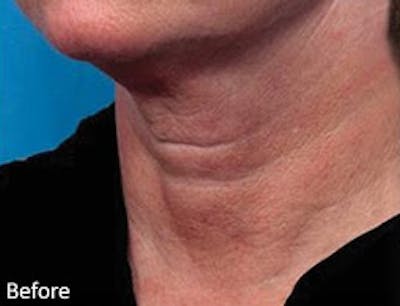 Genius Intelligent RF Before & After Gallery - Patient 271754 - Image 1