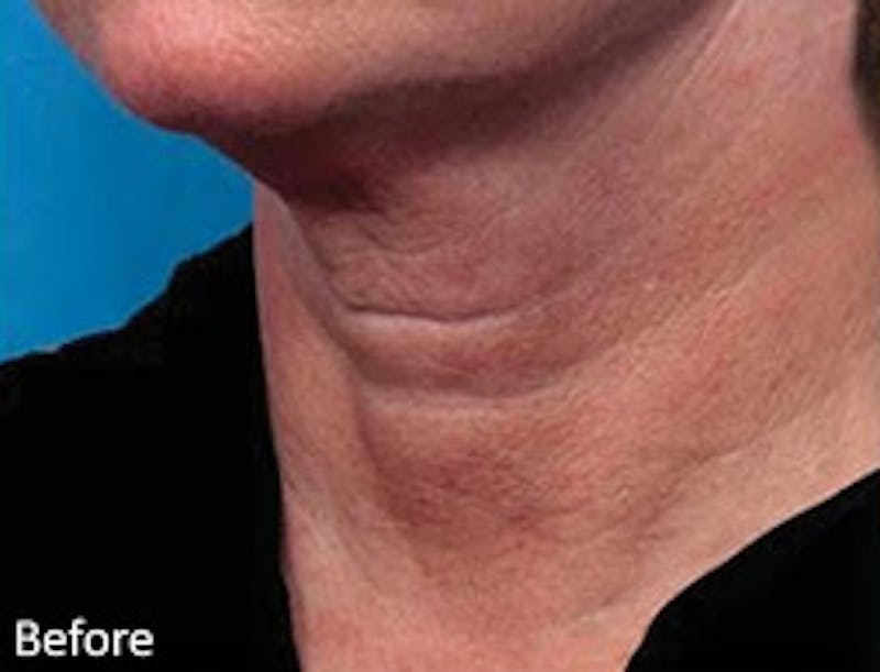 Genius Intelligent RF Before & After Gallery - Patient 271754 - Image 1