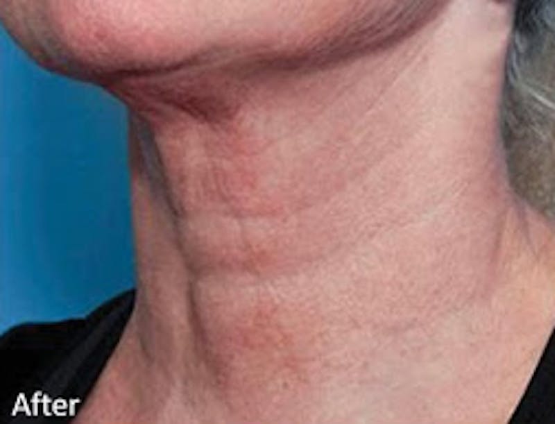 Genius Intelligent RF Before & After Gallery - Patient 271754 - Image 2