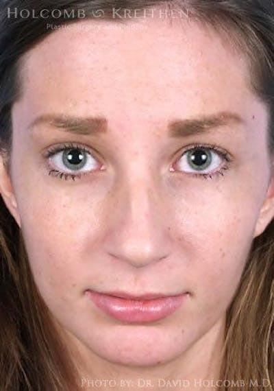 Lip Lift Before & After Gallery - Patient 892545 - Image 1