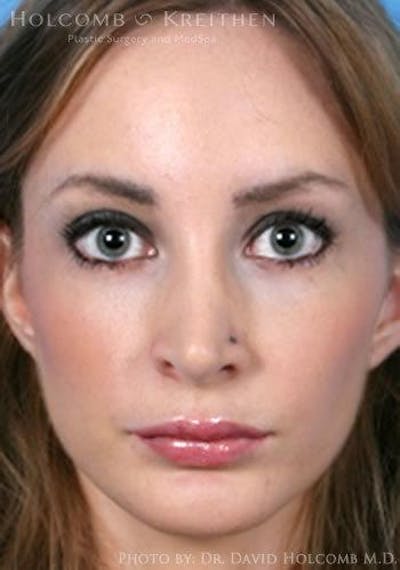 Lip Lift Before & After Gallery - Patient 892545 - Image 2