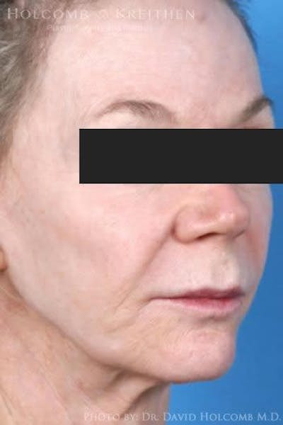 Lip Lift Before & After Gallery - Patient 928789 - Image 1
