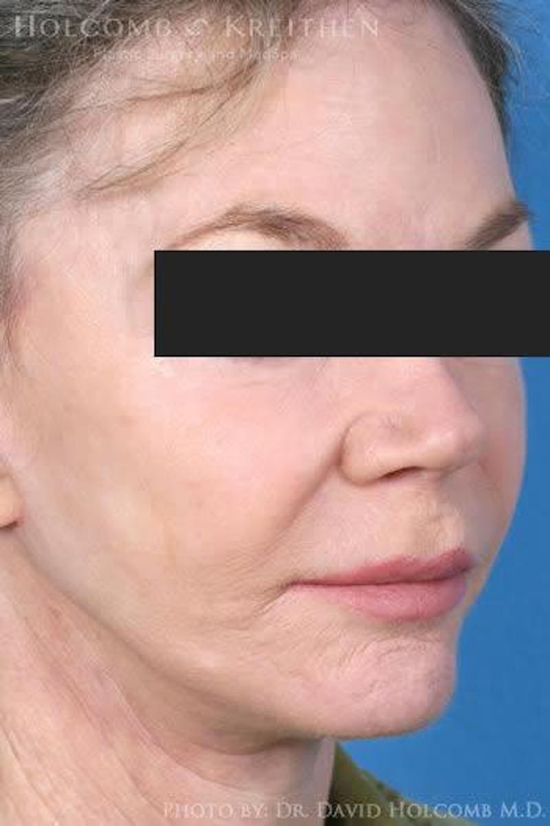 Lip Lift Before & After Gallery - Patient 928789 - Image 2