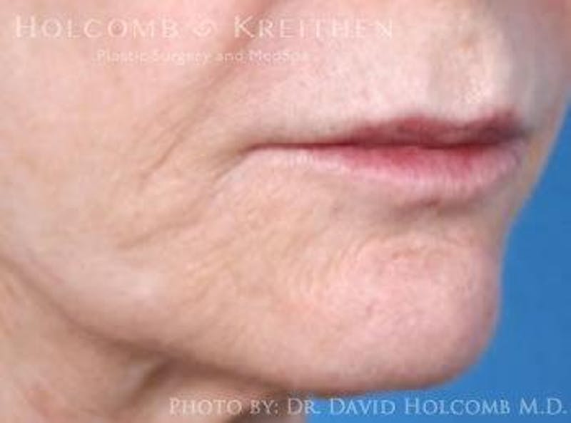Lip Lift Before & After Gallery - Patient 928789 - Image 3