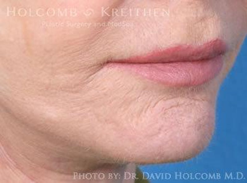 Lip Lift Before & After Gallery - Patient 928789 - Image 4