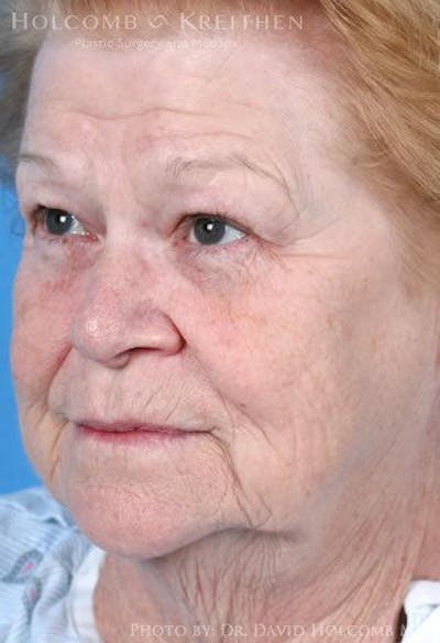 Lip Lift Before & After Gallery - Patient 858548 - Image 1
