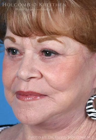 Lip Lift Before & After Gallery - Patient 858548 - Image 2