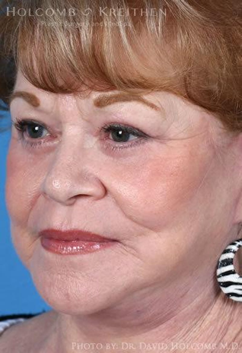Lip Lift Before & After Gallery - Patient 858548 - Image 2