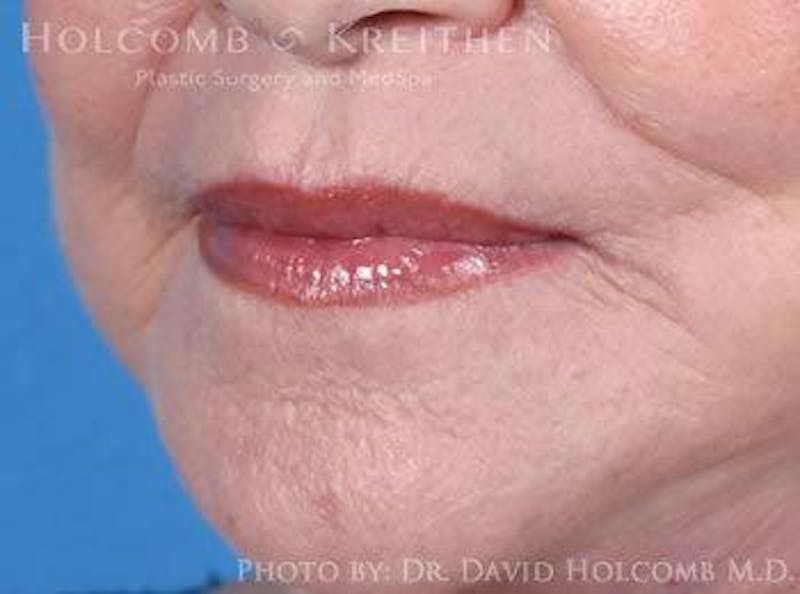 Lip Lift Before & After Gallery - Patient 858548 - Image 4