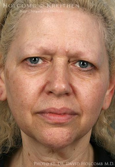 Neck Contouring Before & After Gallery - Patient 405745 - Image 1
