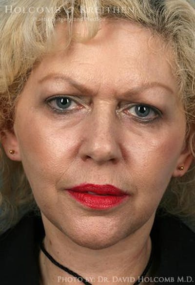 Neck Contouring Before & After Gallery - Patient 405745 - Image 2