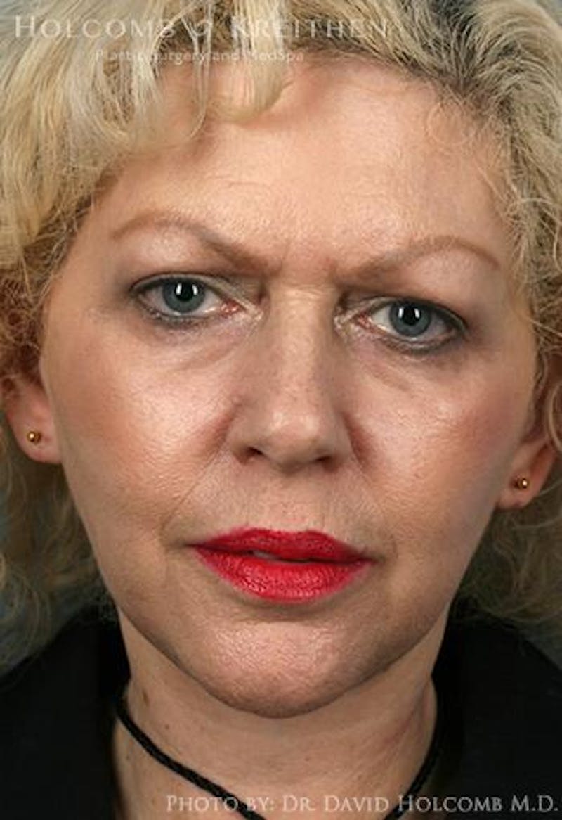 Neck Contouring Before & After Gallery - Patient 405745 - Image 4