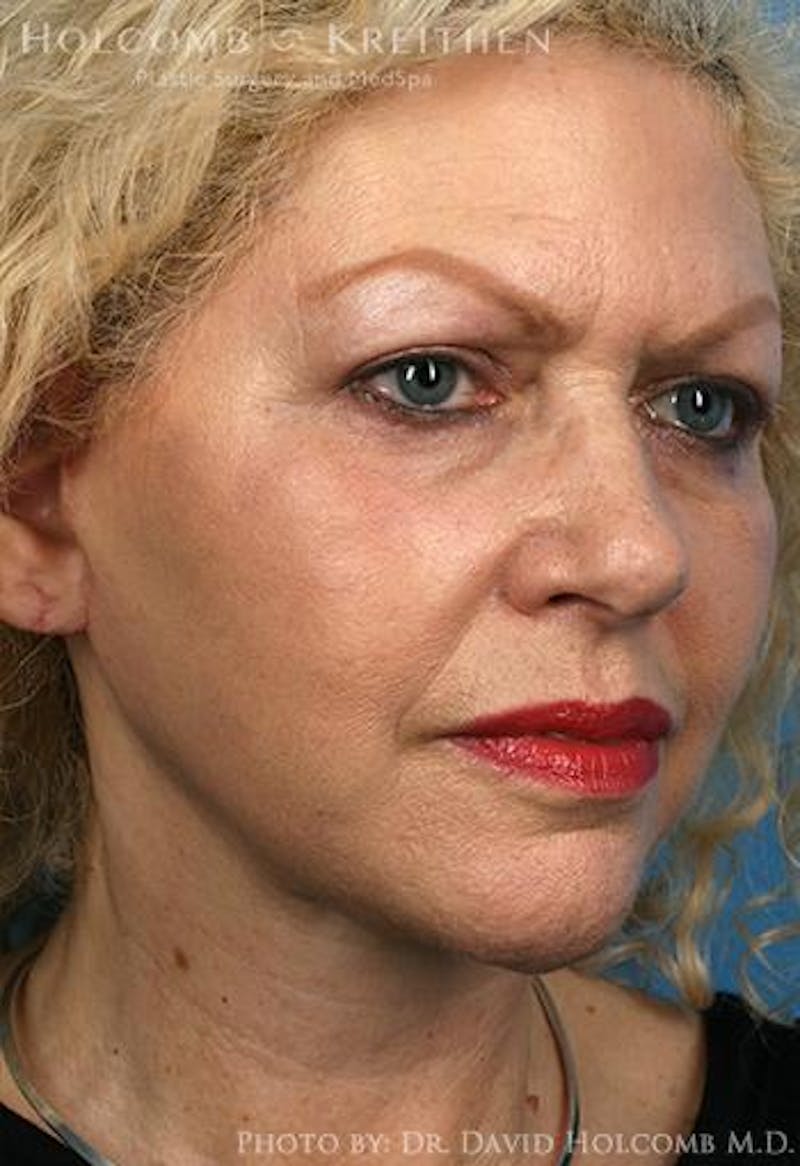 Neck Contouring Before & After Gallery - Patient 405745 - Image 6