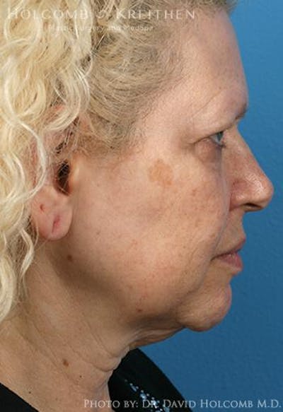 Neck Contouring Before & After Gallery - Patient 405745 - Image 1