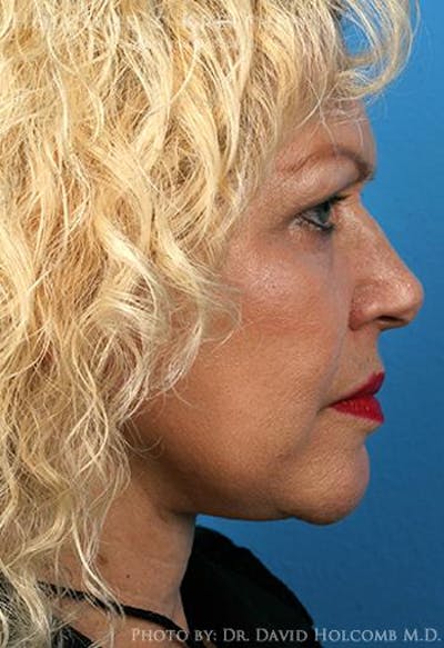 Neck Contouring Before & After Gallery - Patient 405745 - Image 2