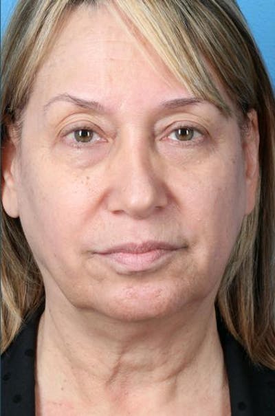 Neck Contouring Before & After Gallery - Patient 217118 - Image 1
