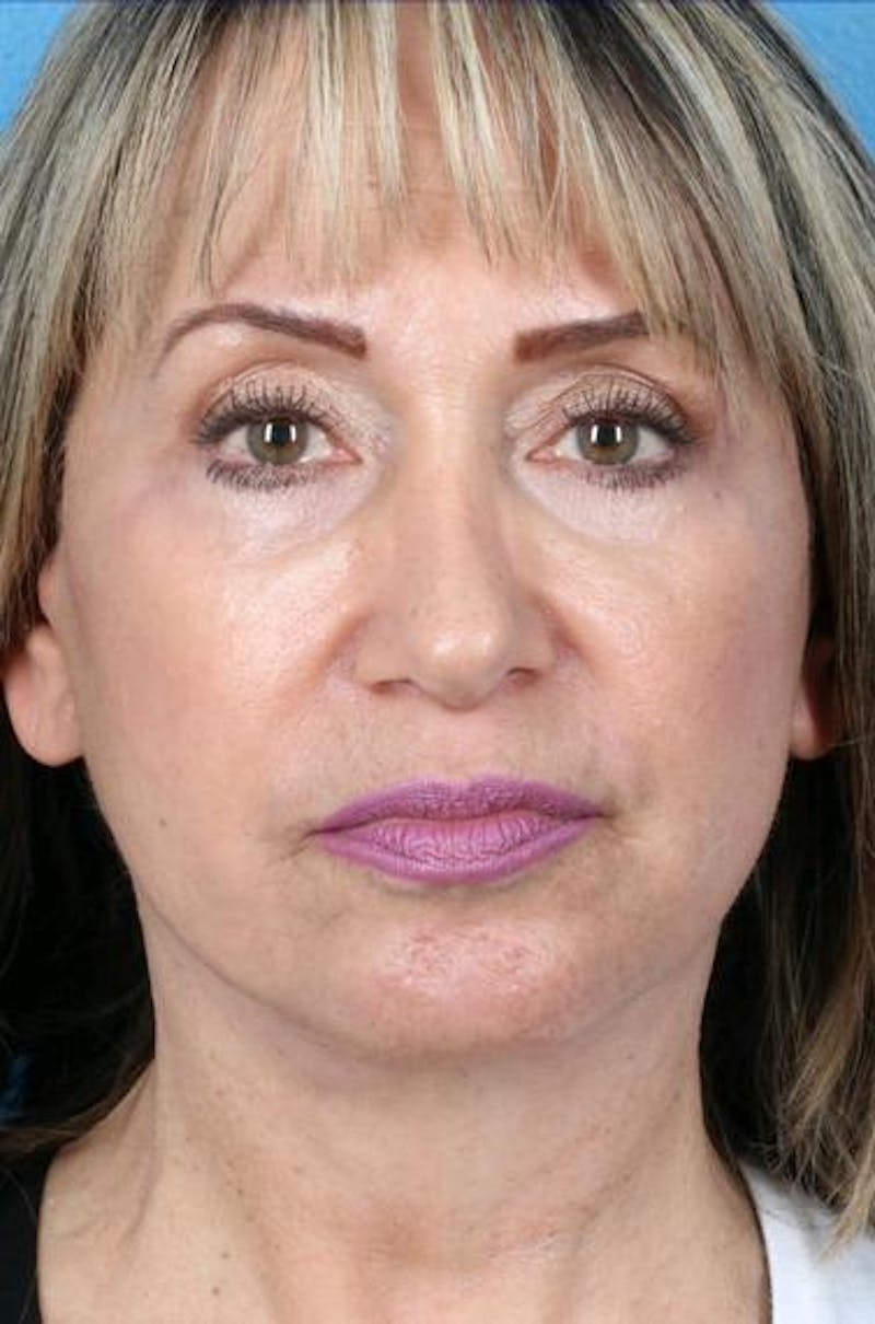 Neck Contouring Before & After Gallery - Patient 217118 - Image 4