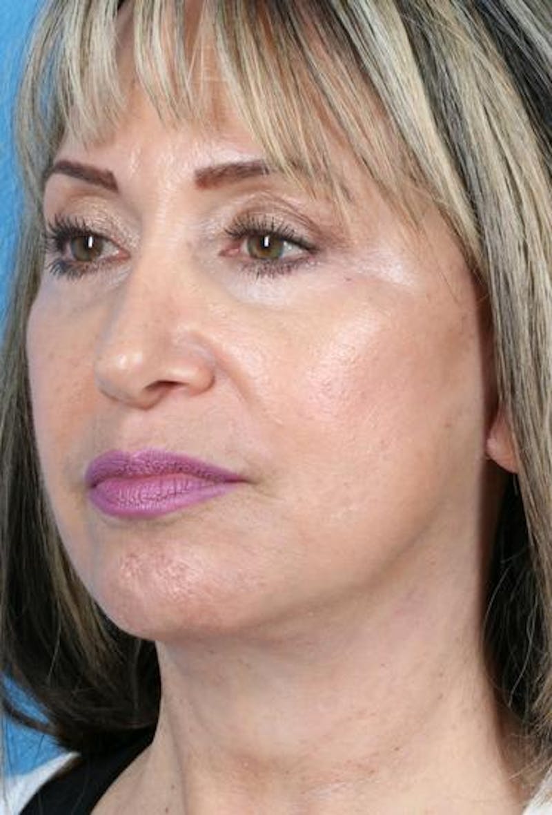 Neck Contouring Before & After Gallery - Patient 217118 - Image 6