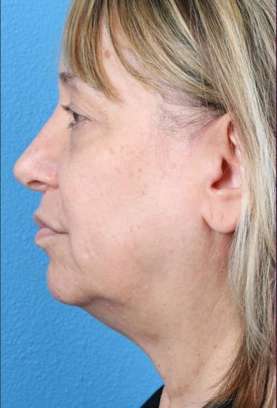 Neck Contouring Before & After Gallery - Patient 217118 - Image 1