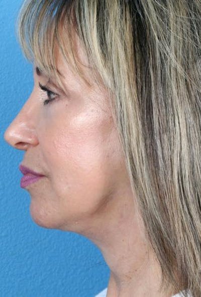 Neck Contouring Before & After Gallery - Patient 217118 - Image 2