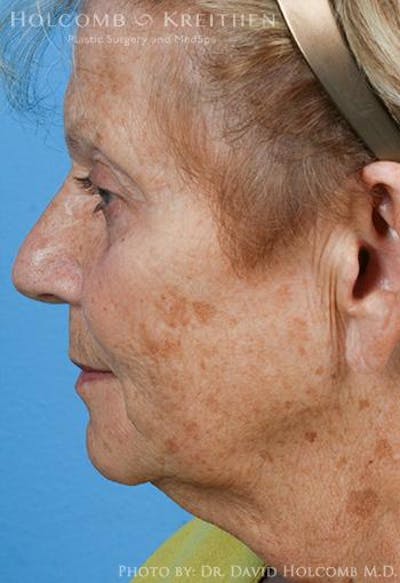 Neck Contouring Before & After Gallery - Patient 550178 - Image 1