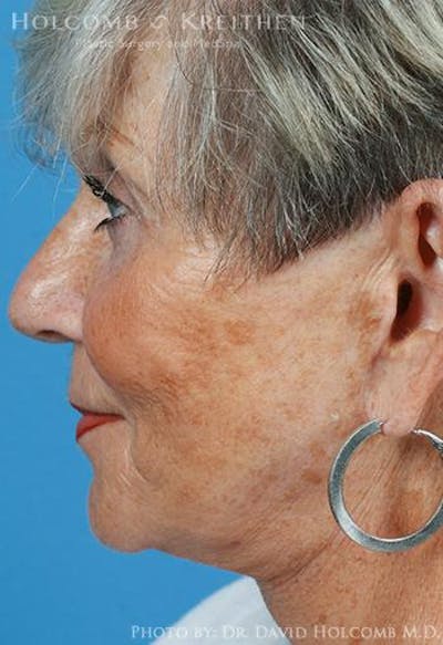 Neck Contouring Before & After Gallery - Patient 550178 - Image 2
