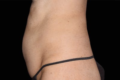 Emsculpt NEO Before & After Gallery - Patient 381801 - Image 1