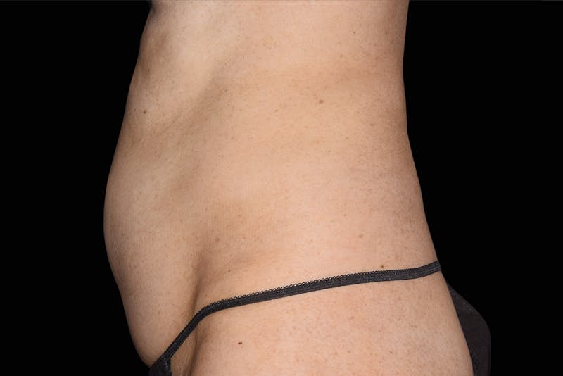 Emsculpt NEO Before & After Gallery - Patient 381801 - Image 1