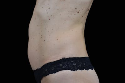 Emsculpt NEO Before & After Gallery - Patient 321200 - Image 1