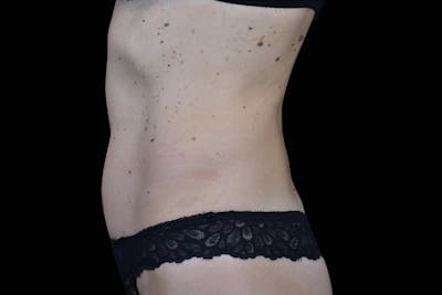 Emsculpt NEO Before & After Gallery - Patient 321200 - Image 2